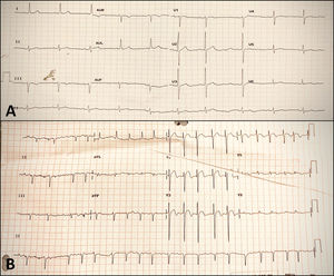 Baseline and follow-up electrocardiograms. (A) Baseline electrocardiogram with sinus rhythm and no ischemic or necrotic changes; (B) electrocardiogram during chest pain on the fifth day of hospitalization, showing atrial fibrillation and ST-segment elevation in leads V1-V4.