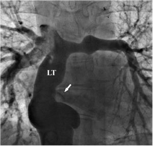 Venography from the inferior vena cava shows the lateral tunnel (LT) total cavopulmonary connection. There is also a fenestration in the lateral tunnel opening into the left atrium (arrow).