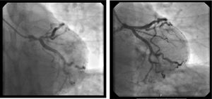 A – Lesão crítica da descendente anterior ostial e proximal. B – Angiografia da descendente anterior após implantação de stent 3,5 x 28mm.