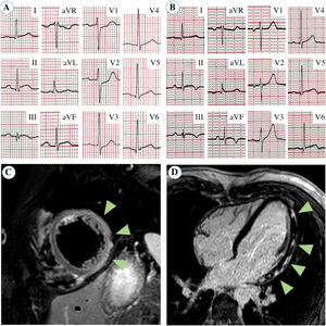 Electrocardiogram and cardiac magnetic resonance. (A) Electrocardiogram at admission showed mild ST-segment elevation in inferior leads (II, III, aVF) and mild ST-segment depression in V1 to V3. (B) At discharge, ST-segment was normalized but T-wave inversion occurred in inferior leads. (C) On cardiac magnetic resonance, T2-weighted short-tau inversion recovery sequence showed myocardial signal intensity increase (edema) in inferior, inferolateral and anterolateral walls (arrows). (D) Late gadolinium enhancement imaging demonstrated patchy areas of hyper-enhancement with non-ischemic subepicardial distribution (arrows).