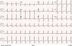 Twelve-lead electrocardiogram. Sinus rhythm, HR=90 bpm; P pulmoale wave; normal atrioventricular and intraventricular conduction; right electrical axis of the QRS in the frontal plane; anticlockwise deviation of the electrical axis of the QRS in the axial plane together with other criteria for right ventricular overload.