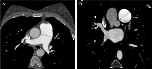 Computerized tomography coronary angiogram. View of the main pulmonary artery, measuring 30 mm in diameter. (A) Axial plane view. (B) Short axis view.