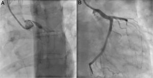 Invasive coronary angiography. (A) Extrinsic compression of the proximal segment of the LCMA from a dilated PA. (B) Angiographic outcome after stent placement.