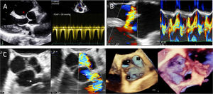 (A) Transthoracic echocardiography showing a perimembranous ventricular septal defect (VSD, asterisk) with severe pulmonary hypertension; (B) two- and three-dimensional transesophageal echocardiography confirming VSD with bidirectional shunting, and unmasking a circular rupture opening of the right sinus of Valsalva aneurysm (6.5 mm×6.7mm, arrow) into the right ventricular outflow tract (C).