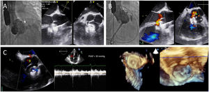 Fluoroscopic and echocardiographic images of the ruptured sinus of Valsalva aneurysm (arrow) during transient percutaneous occlusion testing (A) and after definitive closure (B) with the 12-mm Amplatzer Muscular VSD device, with trace peri-device leak and trivial left-to-right shunt through the VSD; (C) one-year echocardiographic follow-up showing appropriate apposition and sealing of the device and absence of pulmonary hypertension.