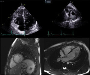 Transthoracic echocardiogram in 4-chamber view of the index patient's son showing biventricular involvement (top left) and a ratio of thickness of noncompacted to compacted layers >2, clearly fulfilling the diagnostic criteria of Jenni et al. for left ventricular noncompaction (LVNC) (top right); cardiac magnetic resonance images in short-axis view of the same patient showing hypertrabeculation (bottom left) and ratio of the thickness of noncompacted to compacted layers >2.3 in 4-chamber view, fulfilling Petersen et al.’s criteria of LVNC (bottom right).