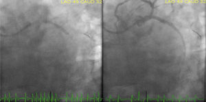 Coronary angiography after aspiration thrombectomy and proximal left circumflex artery stent placement. Sluggish antegrade flow with complete filling of the distal territory (TIMI 2 flow).