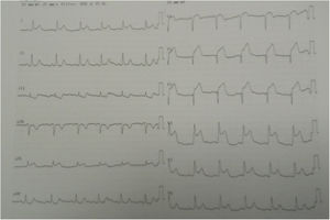 Electrocardiogram documenting acute myocardial Infarction with ST-segment elevation in the anterior and lateral wall leads.