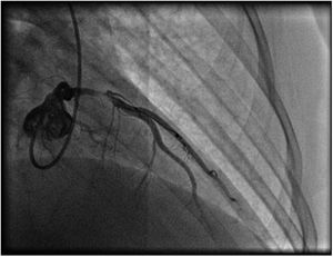 Coronary angiography with subocclusive lesion in the anterior descending coronary artery.