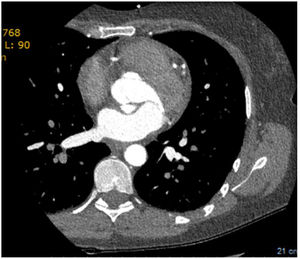 Type A aortic dissection.