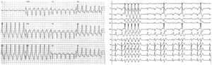 Electrocardiograms of two patients showing sustained monomorphic ventricular tachycardia (left image) and repetitive non-sustained monomorphic ventricular tachycardia (right image). Note the electrocardiographic morphology of left bundle branch block and inferior axis (left panel) and the rapid transition of QRS morphology from V1 to V2 (right panel).