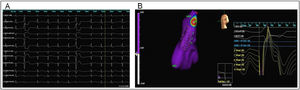 Three-dimensional electroanatomic mapping using the noncontact EnSite 3000. The acquisition of maps during sinus rhythm and ventricular premature complexes (PVC) identifies the early activation points. A: Surface twelve-lead ECG showing isolated monomorphic PVC originating from RVOT (left bundle branch block with an inferior axis pattern). B: Three-dimensional reconstruction of right ventricle outflow tract (left anterior oblique projection) and virtual electrograms at the site of earliest activation (note the QS pattern).