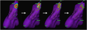 An example of successful ablation. Three-dimensional reconstruction of right ventricle anatomy (left anterior oblique projection) and identification of early activation points, marked in white/red (made possible by the acquisition of maps during sinus rhythm and premature ventricular complexes). Red dots (L1 to L9) indicate the sites of ablation therapy. The early activation point was seen to have moved away from the original site, where the first application was performed. Further ablation at the new site successfully abolished the ectopies.
