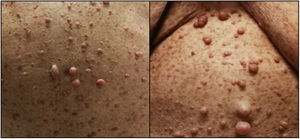 Clinical signs of neurofibromatosis type 1: multiple café au lait spots, axillary freckling, and multiple neurofibromas.
