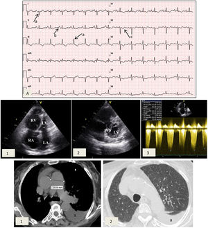 Cardiac studies obtained during medical visits. (A) Electrocardiogram showing right axis deviation >120° (a), right atrial enlargement (b) and right ventricular strain (c); (B) transthoracic echocardiogram depicting (1) enlarged right atrium and right ventricular dilation and hypertrophy and (2) flattening of the interventricular septum and D-shaped left ventricle; (3) pulmonary artery systolic pressure 72 mmHg. IVS: interventricular septum; LA: left atrium; LV: left ventricle; RA: right atrium, RV: right ventricle; (C) high-resolution computed tomography exhibiting (1) enlarged central pulmonary arteries and (2) bilateral mosaic pattern of ground glass haziness. Left pleural effusion is also visible (a).