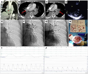 This is the case of a 79-years-old woman admitted with an acute high-risk PE, with contraindication for fibrinolysis due to the presence of a paravertebral mass with medullary compression (A), later diagnosed as a lymphoma (*), underwent endovascular treatment. Axial contrast enhanced computed tomography at time of diagnosis illustrates central extensive bilateral thrombus (red arrows in B and C). Echocardiography at bedside shows an enlarged right ventricle and a flattened interventricular septum in parasternal short axis view (D); Left pulmonary angiography confirm nearly complete obstruction at the origin (E). Aspiration mechanical thrombectomy was performed with the Indigo® CAT8 with improvement of arterial perfusion (F) and venous return (G) of the left lung. Image H displays the extracted clots. There was a decrease in systolic and mean pulmonary artery pressure of 54 and 33 mmHg pre-procedure (I), respectively, to 34 and 20 mmHg post-procedure (J).