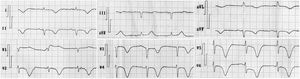 First electrocardiogram recorded at the emergency room. Sinus rhythm, heart rate: 56 beats/minute, QRS axis: -55°, ST depression of 1 mm on DII, aVF and from V3 to V5 and of 2 mm on V6, deep negative T waves in DI, DII, DIII, aVF, aVL and from V1 to V6 leads and prolonged QT interval (QT interval: 642 milliseconds, corrected QT interval by Bazzet formula: 623 milliseconds and corrected QT interval by Fridericia formula: 629 milliseconds).