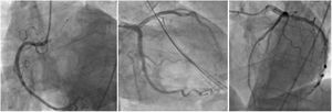Coronary angiography No lesion was found in the three main coronary arteries.