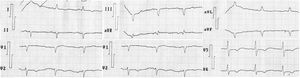 Second electrocardiogram recorded four weeks after goserelin withdrawal. Sinus rhythm, heart rate: 78 beats/minute, QRS axis: -55°, non-specific repolarization abnormalities on DII, DIII, aVF and from V2 to V6, QT interval: 427 milliseconds, corrected QT interval by Bazzet formula: 479 milliseconds and corrected QT interval by Fridericia formula: 464 milliseconds).