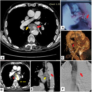 A. Endoscopy of the upper gastrointestinal tract, revealing the presence of blood clot at the proximal esophageal tract (red arrow) with erosion from a pulsative mass. B. Computed tomography angiography of aorta and thorax with intravenous contrast agent, axial view, depicting the presence of a saccular descending aortic aneurysm at the level of the tracheal carina, with mural thrombus (red arrow), and an aortoesophageal fistula blocked by a part of the thrombus, protruding into the esophagus lumen (yellow arrow). C. Computed tomography angiography of aorta and thorax, three dimensional reconstruction, depicting the presence of the descending aortic aneurysm. D. Computed tomography angiography of aorta and thorax with intravenous contrast agent, axial view, depicting the presence of a saccular descending aortic aneurysm at the level of the tracheal carina with the presence of air within the thrombus's layers (red arrows). E. Computed tomography angiography of aorta and thorax with intravenous contrast agent, sagittal view, depicting the aneurysm's mural thrombus (red arrow), protruding into the esophagus lumen (yellow arrow). F. Invasive angiography, showing the result of the thoracic endovascular aortic repair procedure with coverage of the aneurysm with endovascular stent graft (red arrow).