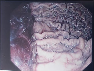 Endoscopy of the upper gastrointestinal tract, depicting the presence of thrombus within the gastric lumen.