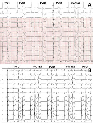 12-lead electrocardiographic traces of patients included in the study, patients 19 and 21. For patient 19 (A), PVC1 and PVC2 were coming from the lateral right ventricular outflow tract and the anterobasal left ventricle, respectively. For patient 21 (panel B), PVC 1 and PVC2 were coming from the anterolateral and posteromedial papillary muscles, respectively.
