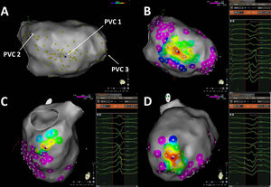 Ablation of multifocal premature ventricular contractions using ...