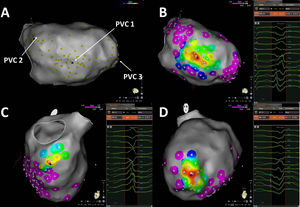 Pace-mapping map generated in patient 1. A total of 99 pacing points were acquired (panel A). The correlation percentage and a color-coded map were automatically generated for each premature ventricular contraction (PVC): 97.1% (mid-inferior left ventricle [LV], panel B), 97.2% (basal inferoseptal LV, panel C) and 99.1% (apical lateral LV, panel D) for PVC1, PVC2 and PVC3, respectively. Local activation time points could only be obtained for PVC1 and PVC2.