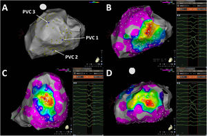 Pace-mapping map generated in patient 2. A total of 142 pacing points were acquired (A). The correlation percentage and a color-coded map were automatically generated for each premature ventricular contraction (PVC): (B) 98.2% (basal inferolateral LV), (C) 95.4% (mid inferior LV) and (D) 99.1% (basal anterolateral LV) for PVC1, PVC2 and PVC3, respectively. No local activation time points could be obtained in this patient due to the paucity of PVCs during the procedure.