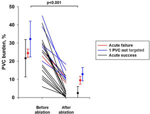 Ablation of multifocal premature ventricular contractions using ...