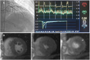 Index of microcirculatory resistance and evaluation of ischemia by coronary microvascular dysfunction in a hypertrophic cardiomyopathy patient. A-catheterization of left anterior descending artery coronary and hemodynamic parameters showed on the dedicated software: Distal coronary pressure (Pd)=66 mmHg, resting mean transit time (Bas)=95 ms, hyperemic mean transit time (Hyp)=32 ms, coronary flow reserve (CFR)=3.0. Calculated index of microcirculatory resistance (IMR) was 20.5 (not shown). B-CMR perfusion images with evidence of perfusion defect (arrow).
