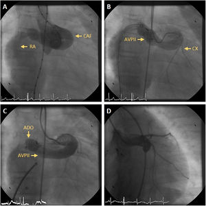 (A) Aortogram showing a coronary artery fistula (CAF) from the left main coronary artery to the right atrium (RA); (B) selective injection in the left main coronary artery after implantation of an Amplatzer Vascular Plug II® (AVPII) device in the CAF, with residual flow via two orifices to the RA; (C) a second device, an Amplatzer Ductal Occluder® (ADO), was implanted in the inferior orifice; (D) follow-up angiography nine months later revealing complete closure of the CAF after the emergence of the circumflex artery (CX).