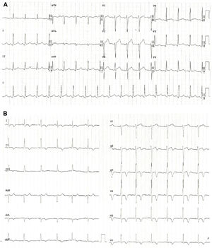 (A) Electrocardiogram at admission revealing a discrete ST-segment elevation in leads II, III, aVF and V2 to V6 and a slightly elevated corrected QT interval; (B) Electrocardiogram performed one day after admission showing a biphasic T wave in lead V2 and negative T waves in leads I, II, III, aVF, aVL and V3 to V6.