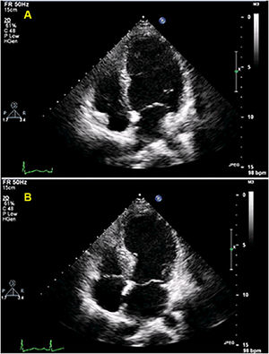 Echocardiogram at admission showing akinesia of the midventricular and apical segments of all walls, hypercontractile basal segments and severely depressed ejection fraction. (A) Apical four-chambers view, diastole; (B) apical four-chambers view, systole.