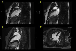 Cardiac magnetic resonance Imaging (Signa HDx 1.5T, GE Healthcare®) showing preserved ejection fraction and absence of late gadolinium enhancement. (A) FIESTA Cine in two-chambers view, diastole; (B) FIESTA Cine in two-chambers view, systole; (C) four-chambers view, after late gadolinium enhancement; (D) two-chambers view, after late gadolinium enhancement.