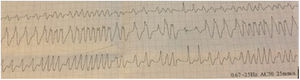 Electrocardiogram on admission showing wide QRS complex irregular tachycardia consistent with pre-excited AF.