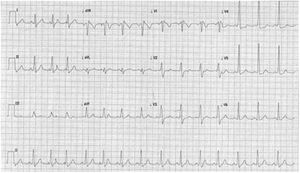 Shortened PR interval, delta wave and widened QRS complex indicative of Wolff-Parkinson-White pattern.