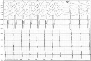 After programmed ventricular pacing, the extra-stimulus maintained eccentric and non-decremental ventriculoatrial conduction up to 220 ms, and it was at this time, when the atrioventricular node was outside the refractory period and available for anterograde conduction, that orthodromic atrioventricular reentrant tachycardia was induced (arrow).