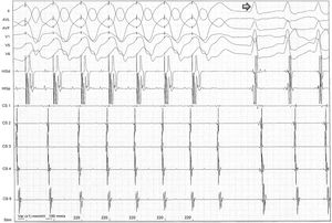 After programmed ventricular pacing, the extra-stimulus maintained eccentric and non-decremental ventriculoatrial conduction up to 220 ms, and it was at this time, when the atrioventricular node was outside the refractory period and available for anterograde conduction, that orthodromic atrioventricular reentrant tachycardia was induced (arrow).