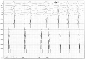 During programmed atrial pacing, atrioventricular conduction was performed through the accessory pathway until its anterograde refractory period (<240 ms) was reached. The impulse then proceeded to the ventricle via the atrioventricular node, leaving the accessory pathway available for retrograde conduction, and atrioventricular reentrant tachycardia had started (arrow).