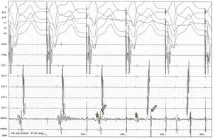 Ablation of a left lateral accessory pathway with criteria of success. Shortly (about 3 s) after the onset of ablation, the ventricular (stars) and atrial (arrows) signals separate, suggesting elimination of the accessory pathway, and conduction begins through the AV node.