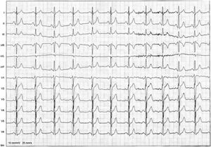 Electrocardiogram performed after catheter ablation showing normal sinus rhythm, without evidence of pre-excitation.