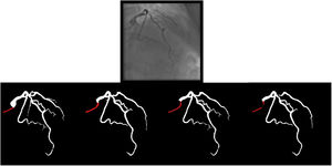 (left to right): The first human segmentation incorrectly labels contrast backflow as coronary. The baseline AI model improves on the human segmentation but is still not perfect. The enhanced human model segments the transition perfectly. The enhanced AI model is hampered in catheter segmentation but identifies the transition correctly.