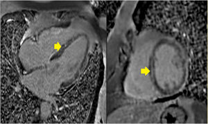 Cardiac magnetic resonance imaging – long and short axis views of mid-wall late enhancement involving the middle segments of the ventricular septum and a less evident subepicardial late enhancement involving the middle segments of the lateral wall (arrow).