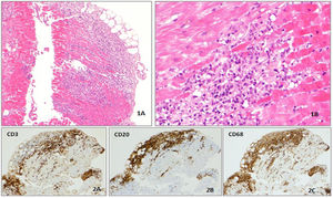 Histological analysis of endomyocardial biopsy. (1A and 1B) Multifocal inflammatory infiltrate in myocardium, with myocyte dropout (100× and 200× hematoxylin and eosin staining). (2A, 2B and 2C) The inflammatory infiltrate is polyclonal, mostly composed of lymphocytes (CD3 and CD20 positive) and macrophages (CD68 positive) (immunohistochemical analysis).