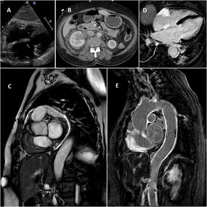 A: Ecocardiography showing mass at the auriculoventricular sulcus; B: Perirenal and retroperitoneal fibrosis seen in computed tomography; C: Magnetic resonance imaging (MRI) showing cardiac mass and hypointense tissue surrounding right atrium; D and E: MRI, inversion-recovery sequences showing intense enhancement in heart mass and aortic wall.