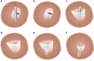 Standard percutaneous suture-mediated patent foramen ovale closure with the NobleStitch® EL system. After placement of a 0.032́́ wire in the left superior pulmonary vein and a 0.018́́ wire in the superior vena cava, the NobleStitch secundum and primum catheters are sequentially advanced to suture (a) the septum secundum and (c) the septum primum, respectively. (b, d) After each NobleStitch needle firing, the delivery system is removed providing a long loop of suture through each septum. Finally, the suture ends are pulled to bend the septum primum towards the right atrium and close the PFO. At the same time, the KwiKnot delivery system is advanced to release a polypropylene knot at the right side of the interatrial septum and trim the excess thread (e, f) (drawing and description adapted from Gaspardone et al.8).