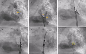Fluoroscopy sequence of PFO closure with the NobleStitch® EL system. (1) Initial angiography showing contrast passage (yellow arrow) through the PFO. (2) Sizing balloon interrogation during contrast injection of the PFO outlines the septum secundum and septum primum anatomy. After placement of a 0.032́́ wire in the left superior pulmonary vein and a 0.018́́ wire in the superior vena cava, the NobleStitch secundum (3) and primum (4) catheters are sequentially advanced to suture the septum secundum and the septum primum (5), respectively. Contrast may be injected to help optimal engagement of each septum. After each needle firing, the delivery system is removed, providing a long loop of suture through each septum. The delivery system is advanced to release a polypropylene knot (6; yellow circle) at the right side of the interatrial septum and trim the excess thread. SP: septum primum; SS: septum secundum.