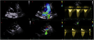(a) Modified parasternal short axis view of the main pulmonarty artery (PA) and its bifurcation. (b) Same view with colour doppler, revealing turbulent flow in the left pulmonary artery (LPA). (c) Doppler derived mean pressure gradient across the LPA stenosis was estimated at 20 mmHg. (d) Suprasternal view of the aortic arch where the echodense structure is visualized. (e) Same view with colour doppler aliasing. (f) Doppler derived mean pressure gradient across the descending aorta stenosis was 19 mmHg.