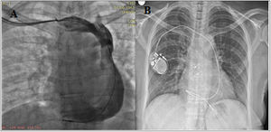 A. Venogram from the right upper limb showing the absence of a right SVC with the persistent left superior vena cava draining into the dilated coronary sinus. B. Chest X-ray demonstrating the loop configuration of the ventricular lead of the VVIR pacemaker.